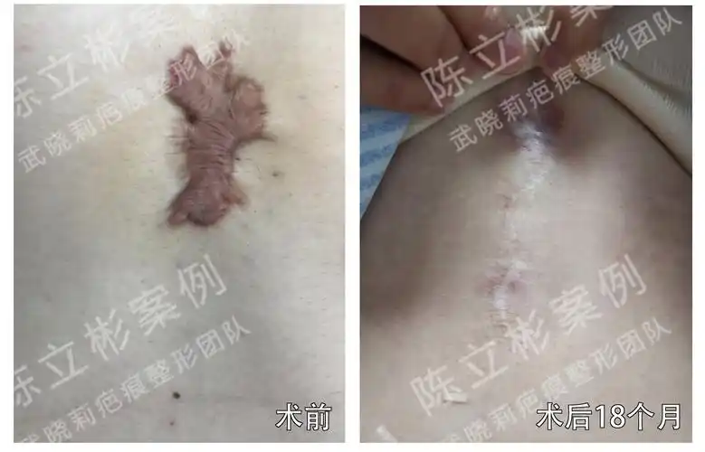胸部疤痕疙瘩术后18个月复诊记录