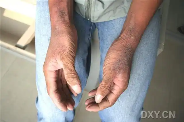 【病例讨论】水源性掌跖角化病(aquagenic palmoplantar keratoderma)