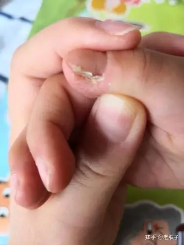 甲周疣怎么办 - 知乎