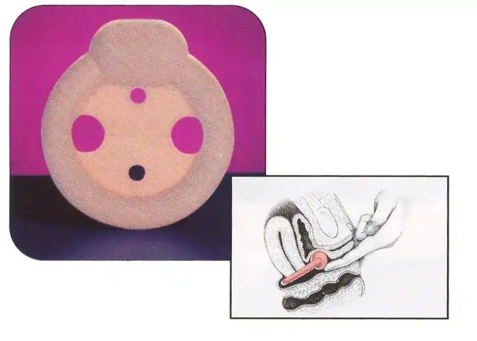(子宫托)对于轻度,中度的阴道壁膨出和子宫脱垂,也可以尝试电刺激和