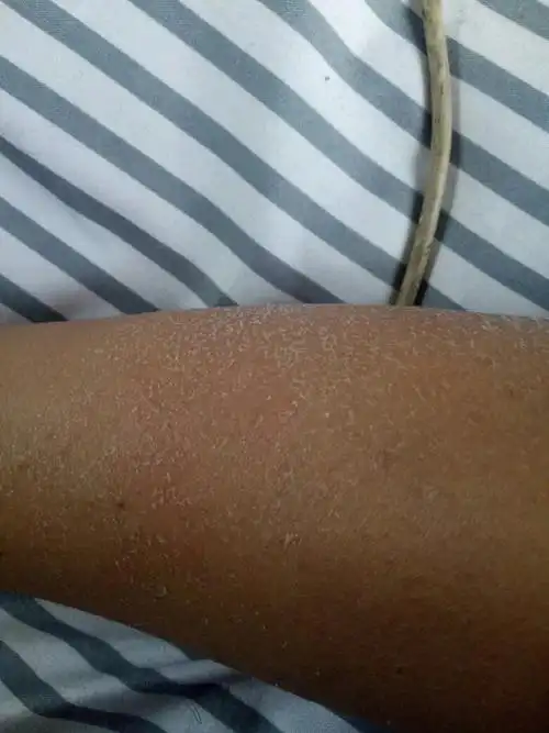 我这是怎么回事,腿上跟胳膊都有这种皮屑怎么回事,有什么治疗方法吗!