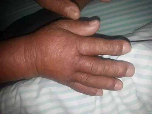 急性髓性白血病