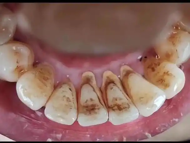 别再盲目洗牙了!过来人支你一招,烟牙分分钟亮白!