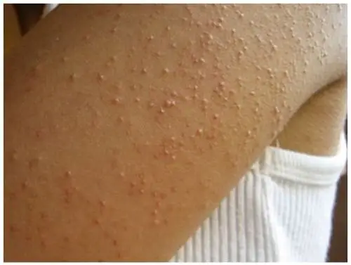 毛周角化症图片 (25)_有来医生