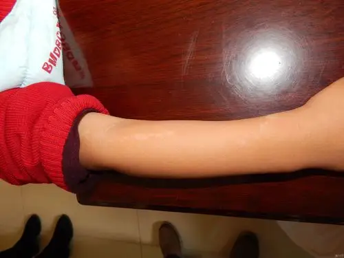 病例讨论男孩手臂上的白斑