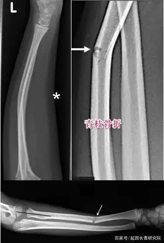 「起因科技」钙与骨骼发育的因果|必需补钙吗?