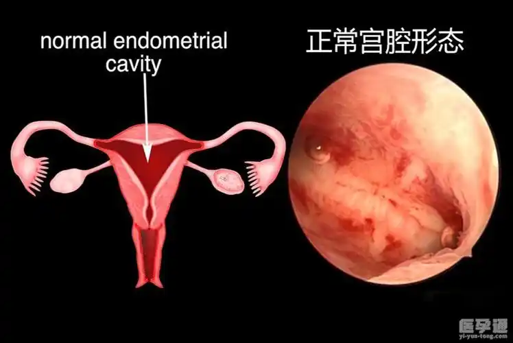 宫腔镜检查后多久能做试管还需结合自身情况而定