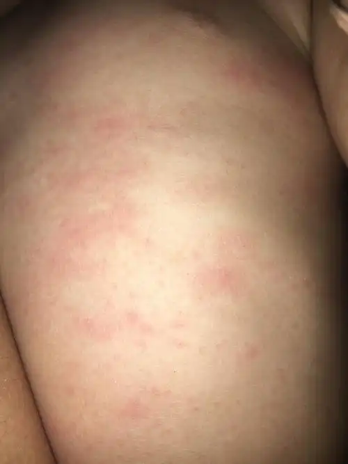 宝宝身上有很多红色的疙瘩