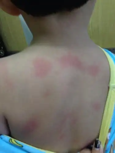 十五个月宝宝身上多处红,有白色疹子,时有时无,晚