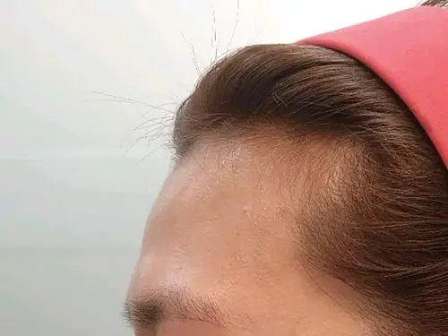 额头的填充效果我太满意了,之前额头扁平,眉心跟鼻子_圈子-新氧美容