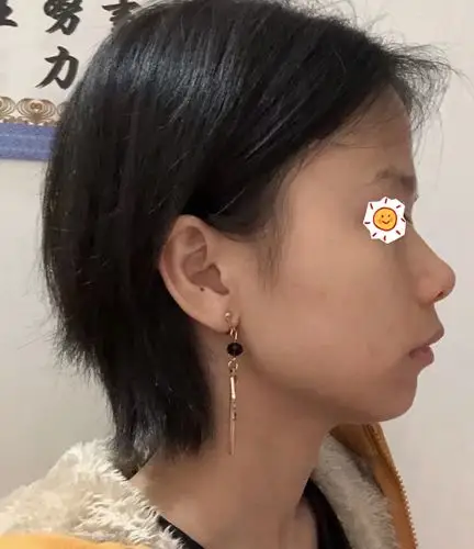 姐妹们,我这个骨性凸嘴严重吗?