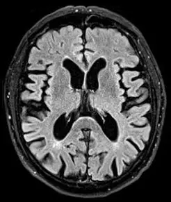 干货:如何准确鉴别脑积水与脑萎缩?