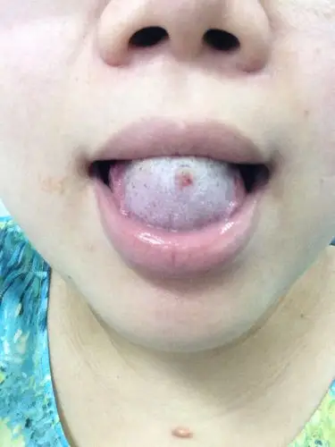 舌头上长了个东西,现在大了不疼不痒,到底是什么啊?求懂得人帮我看看!