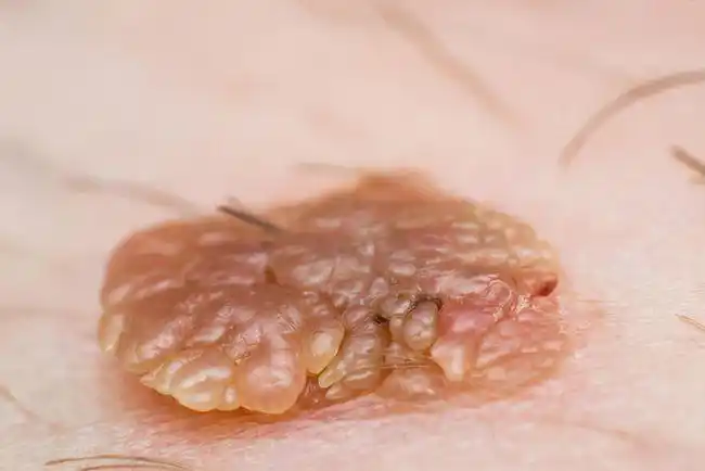 感染hpv应该怎么办hpv症状如何治疗和预防