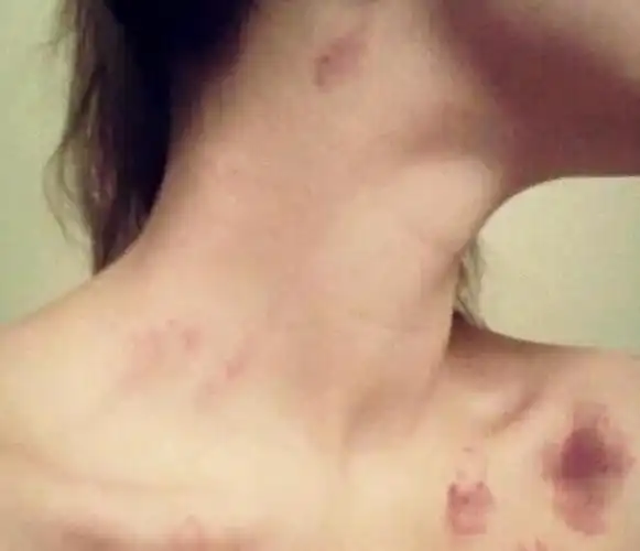 就会在体表留下印记,因为脖子部位的皮肤比较薄,所以脖子处的吻痕比较