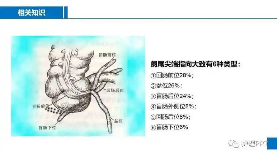急性化脓性阑尾炎护理查房