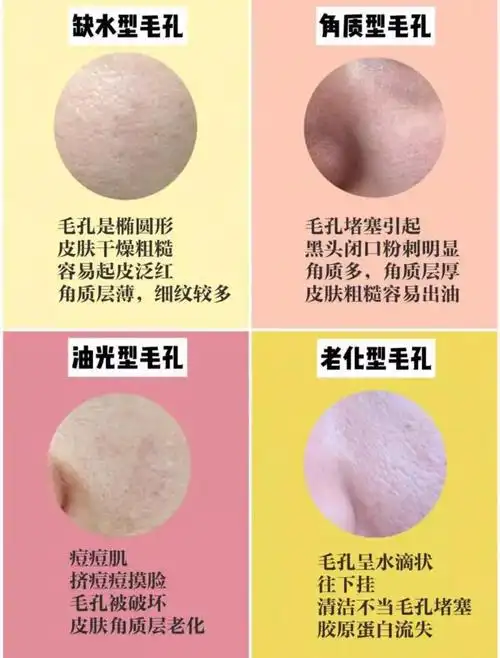 毛孔粗大四种毛孔类型带你找孔真相
