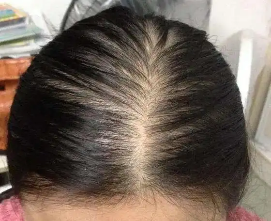 脂溢性脱发的原因有哪些-珠海香洲皮肤病医院_珠海市皮肤科医院_珠海