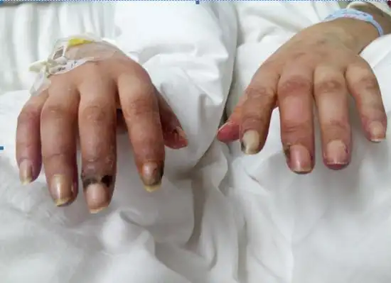 都说"十指连心",我们手指头被针扎一下都觉得疼痛难忍,可怀化24岁的