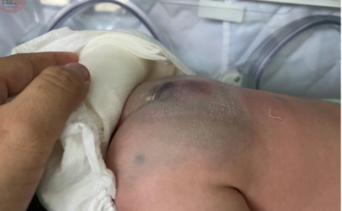 多学科接力治愈脊柱裂新生儿,国际医院获家长点赞