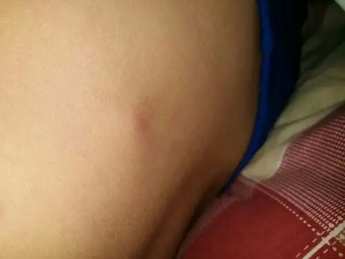 这个是什么鬼,长在腰上的,按起来会痛,好像肿起来的一样