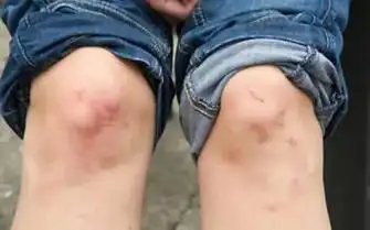 滑膜炎为什么经常会复发