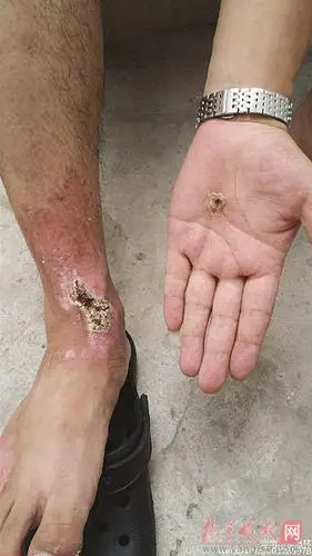 男子钓鱼甩杆碰高压线10千伏电穿身过被烧伤