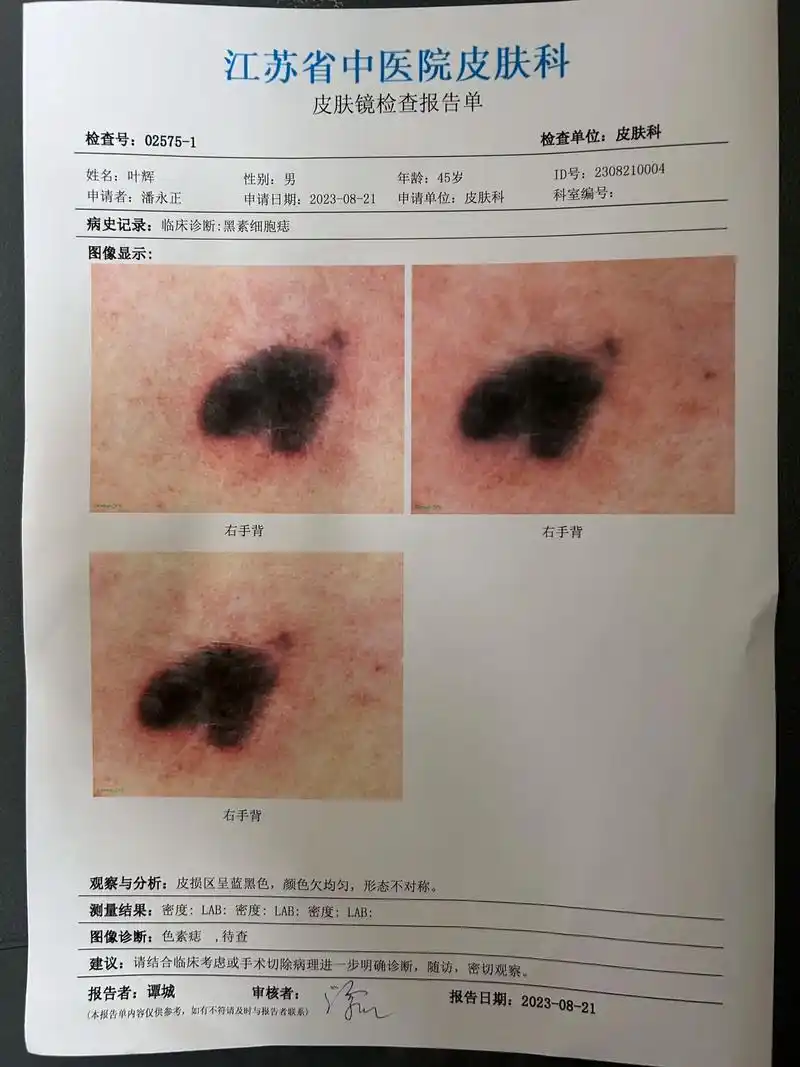 就是一个黑色素瘤,不疼也不痒,但从以前半个芝麻粒大小长到现在 - 抖