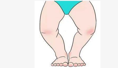 o型腿在医学上称为膝内翻,俗称"罗圈腿","弓形腿","箩筐腿".