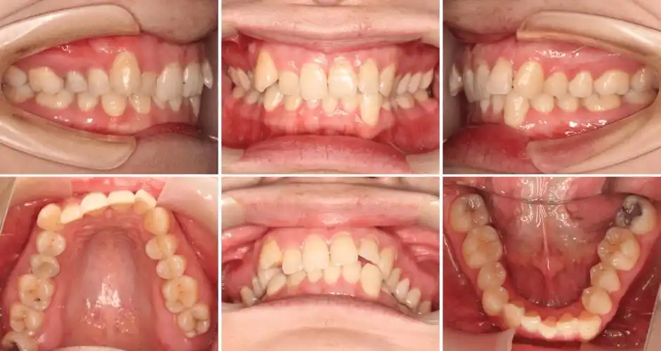 隐形矫正 扩弓,牙齿拥挤少女收获甜美笑容 - 贝致案例库 - 贝致