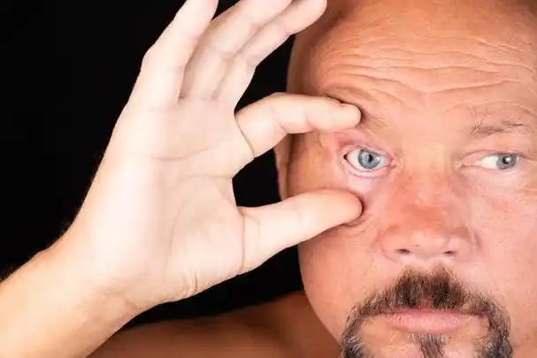 青光眼是一种慢性疾病,通常在早期没有症状,因此很难被发现.