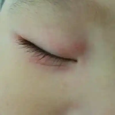 8个月29天我家宝宝9个月了是吃母乳,眼角边上起了好多小红疙瘩,是怎麼