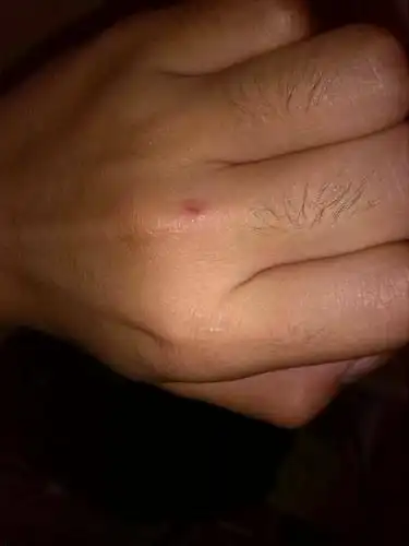 如果被蝙蝠咬了伤口 形状是怎么样的?求专家大神