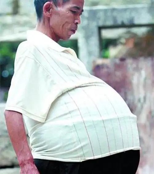 男人肝腹水图片_有来医生