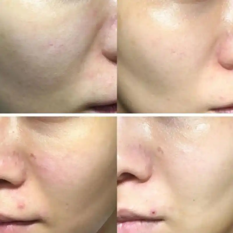 毛孔粗大的原因和类型 一,缺水型毛孔粗大形状多为椭圆形,表现为皮肤