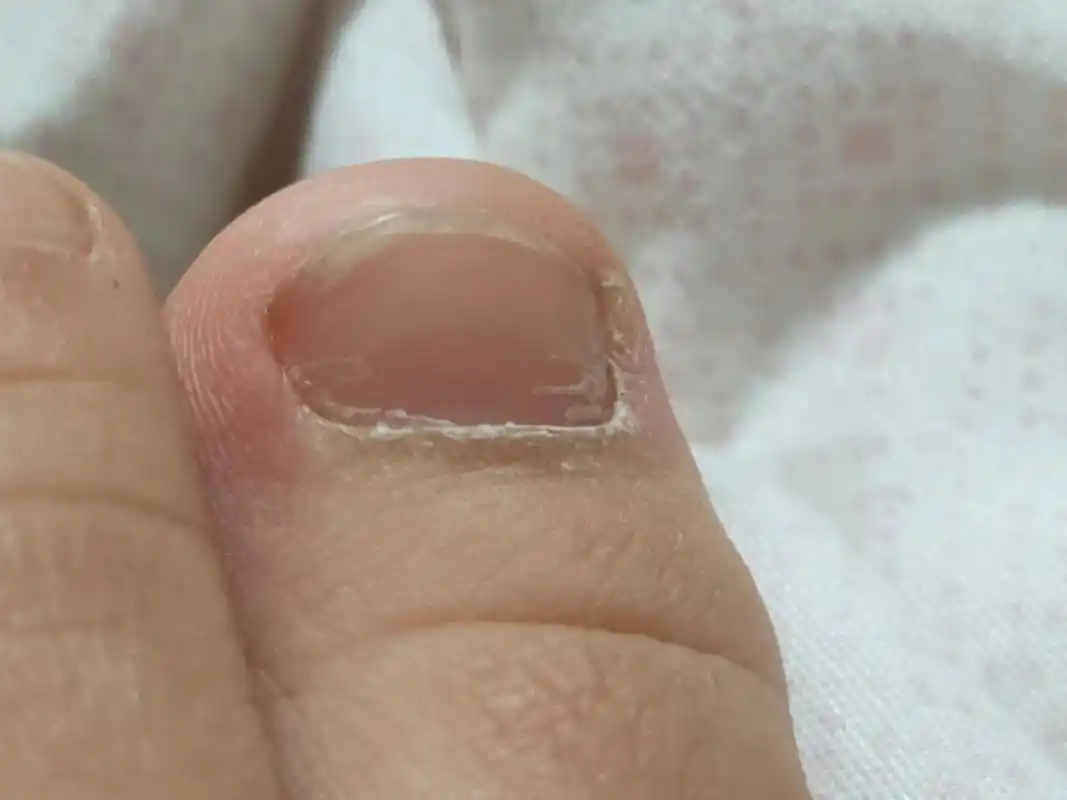 一直以为她是缺钙或者缺什么元素导致脚趾甲会这样!今天才 - 抖音