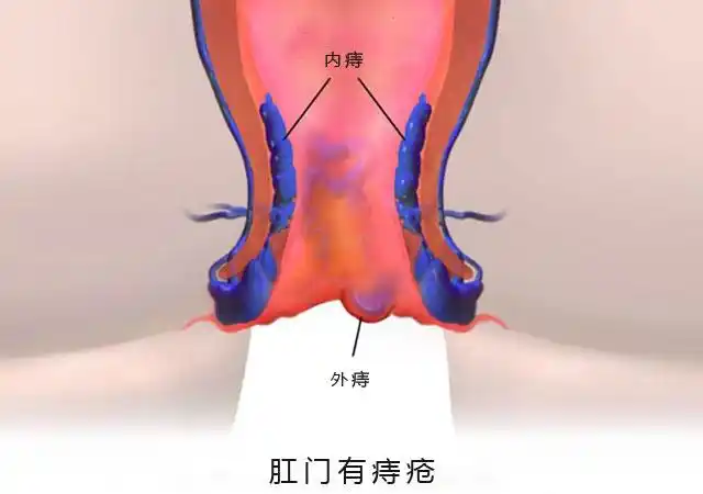 女性初期轻微内痔疮外痔疮图片样子大全及类型