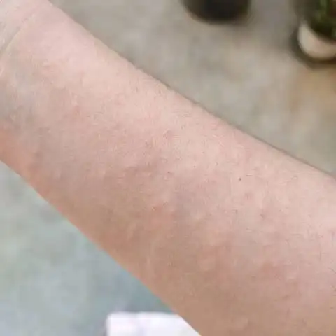 有人知道这是皮肤过敏还是怎么了前一段时间经常吃虾手臂