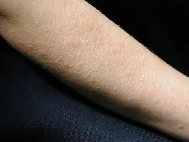 多形日光疹:右前臂伸侧粉红色丘疹和斑块(图片来源:nahhas af 等