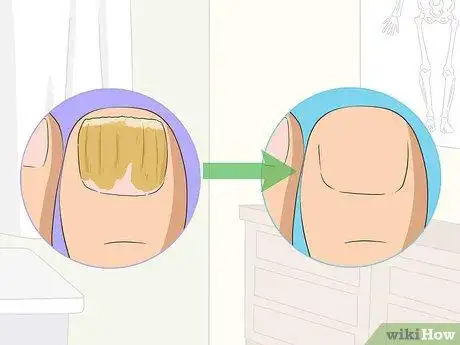 3种方法来治疗灰指甲(脚趾甲真菌症)