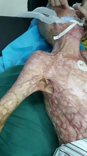 腋窝疤痕畸形手术前后对比 - 好大夫在线