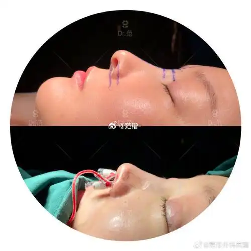 上海鼻修复##上海范锴##鼻翼缘后缩矫正