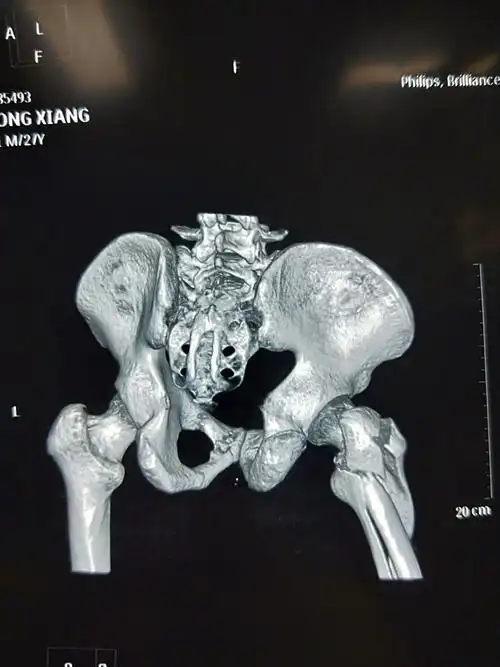 新年一例股骨近端粉碎性骨折的手术治疗!