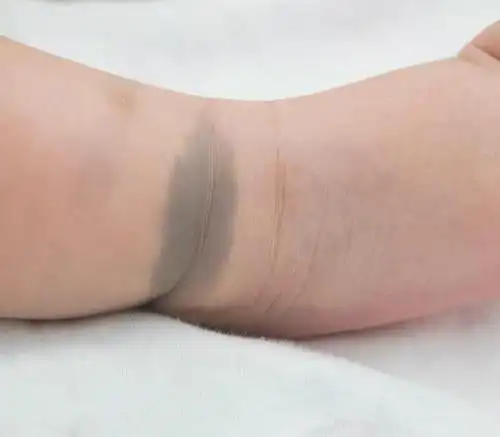 宝宝9种胎记大盘点,妈咪要做到心中有数!