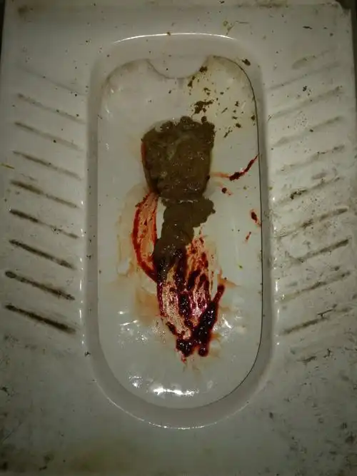 学佛打坐5天,今天大便拉血,怎回事