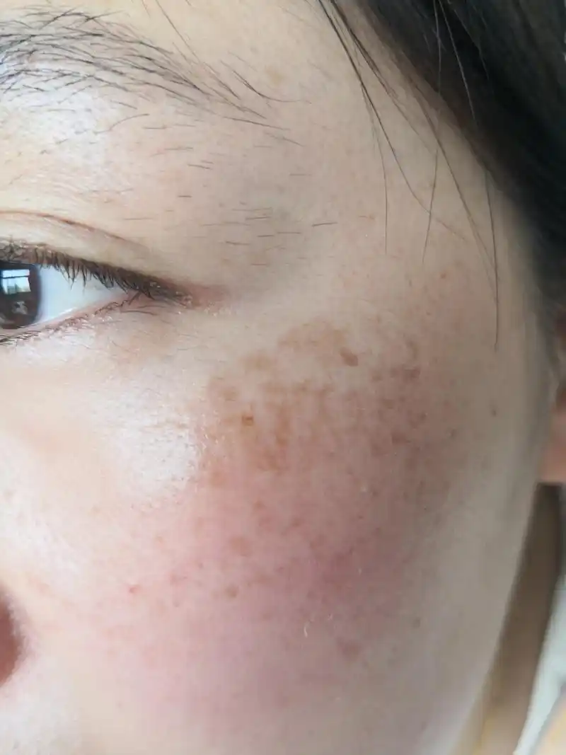解决皮肤问题专注皮肤美容#黄褐斑