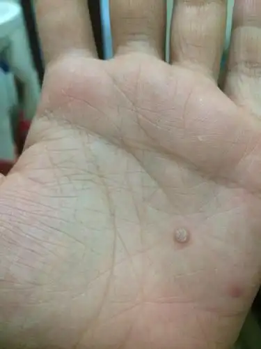 问:求看一下我手上长了一个什么东西.