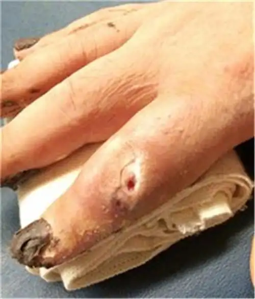 早期骨髓炎治疗图片