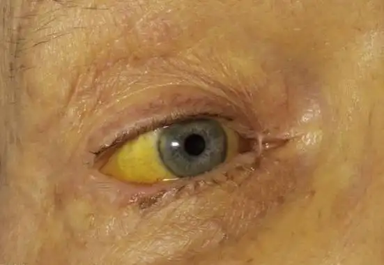 病因,及时的进行预防,乙肝疾病会有一定的潜伏期,患者常常会出现黄疸