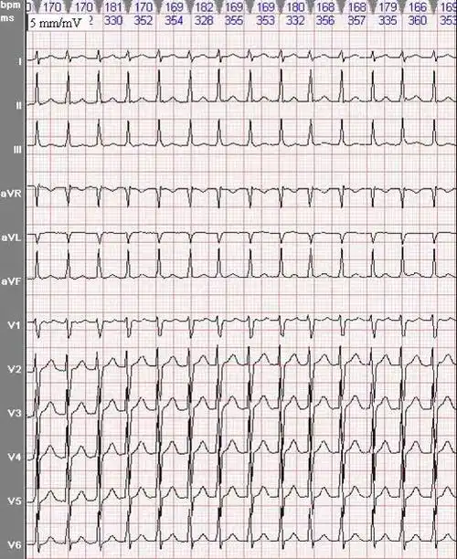 看了它你就懂看和处理常见心电图非专科中级篇一
